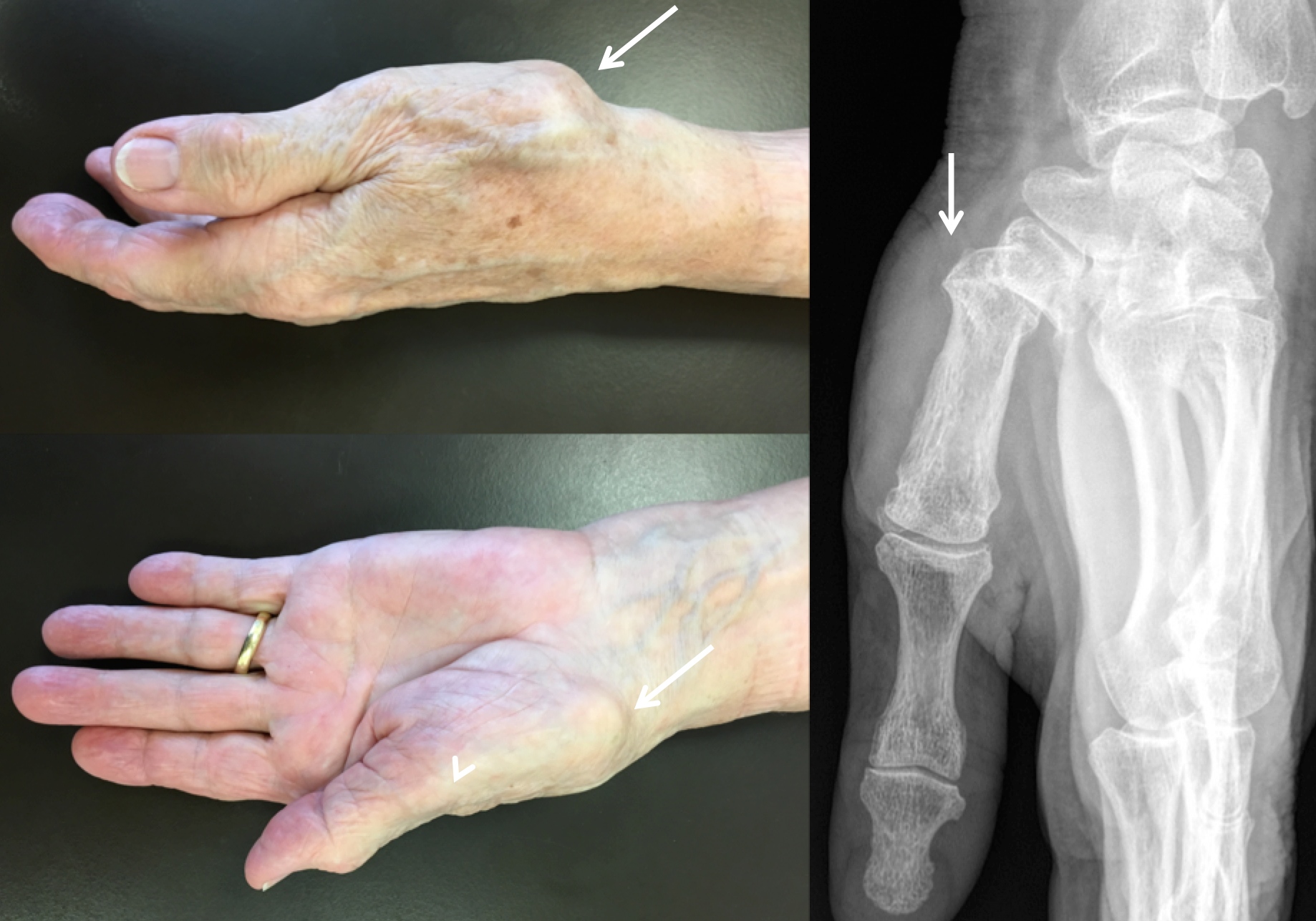 Rhizarthrose / Arthrose du pouce Clinique Ostéo Articulaire des Cèdres Grenoble